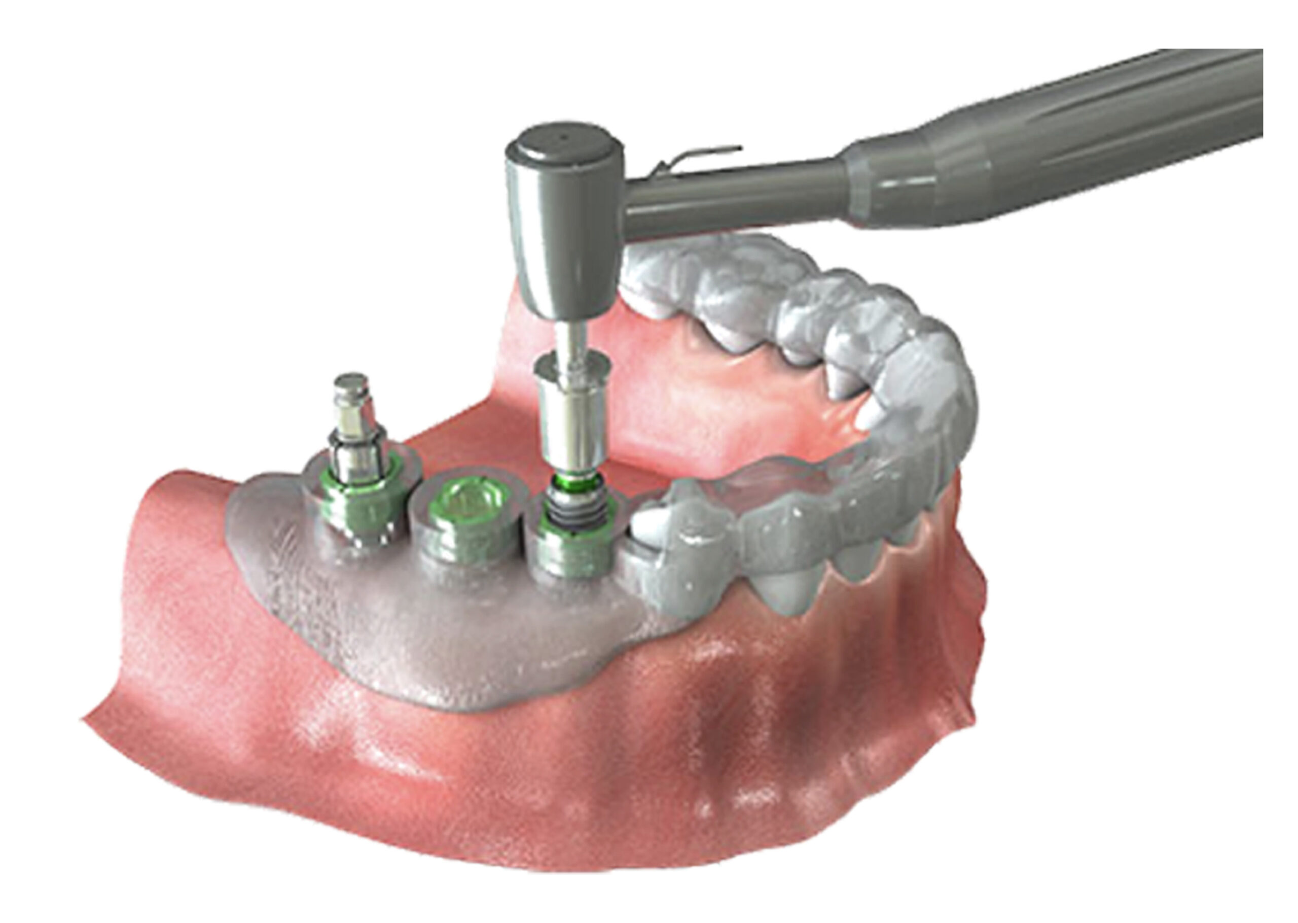 https://www.smilepartners.it/wp-content/uploads/2020/02/implant1-scaled.jpg