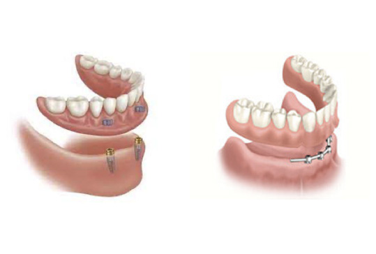 https://www.smilepartners.it/wp-content/uploads/2024/10/overdenture.jpg